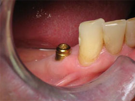 Mandibular Premolar Implants for Lower Partial Overdenture After