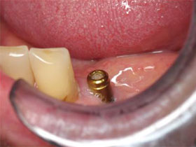 Mandibular Premolar Implants for Lower Partial Overdenture After