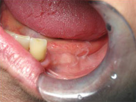 Mandibular Premolar Implants for Lower Partial Overdenture Before