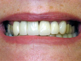 Central and Lateral Incisor Implants After