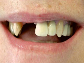 Central and Lateral Incisor Implants Before