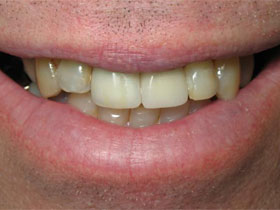 Central Incisor Implant After