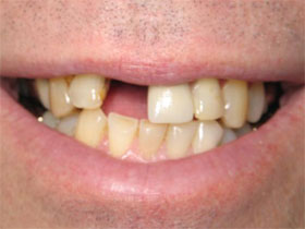 Central Incisor Implant Before