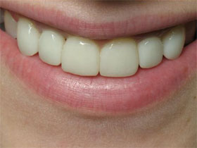 Lateral Incisor Implants After