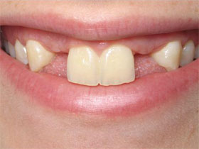 Lateral Incisor Implants Before