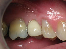 Maxillary Second Premolar After