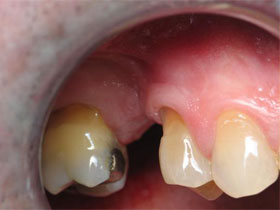 Maxillary Second Premolar Before