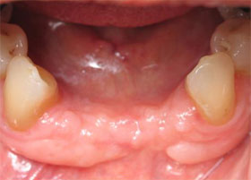 mandibular anterior photo