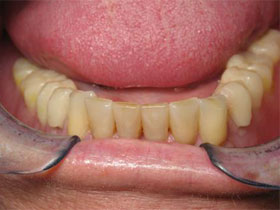 Mandibular Premolar Implants for Lower Partial Overdenture Final Stage
