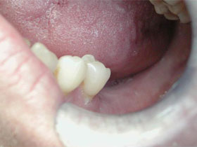 First and Second Molar Implants Before