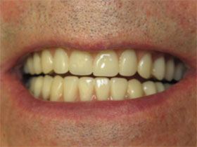 Overdenture After