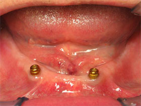 Overdenture Before