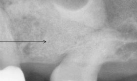 sinus fill with bone