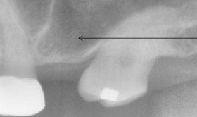 sinus before grafting