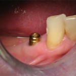 01-mandibular-premolar-after
