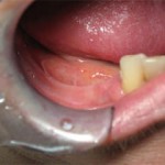 01-mandibular-premolar-before