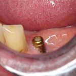 02-mandibular-premolar-after