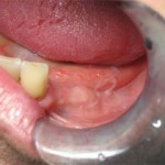 02-mandibular-premolar-before